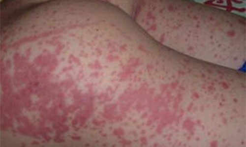 ʲô�ǹ�������� ���������֢״